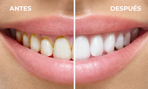 Antes y después de dientes limpios